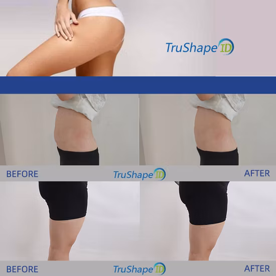 Nouvelle version de l'équipement de soins de la peau Trusculpt ID monopolaire RF brûlant les graisses