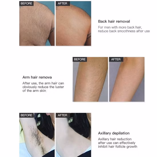 Prix ​​​​de gros Traitement au laser Alexandrite Équipement de salon de beauté Nubway Meilleur équipement d'épilation au laser à diode de platine à glace indolore Équipement de beauté